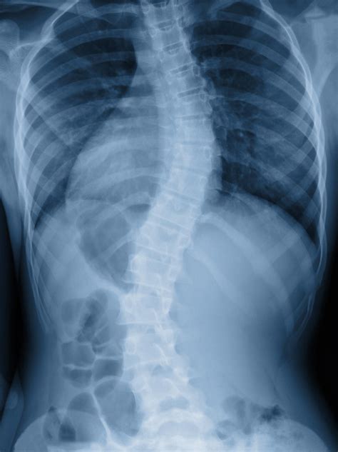 what does a scoliosis exam mean